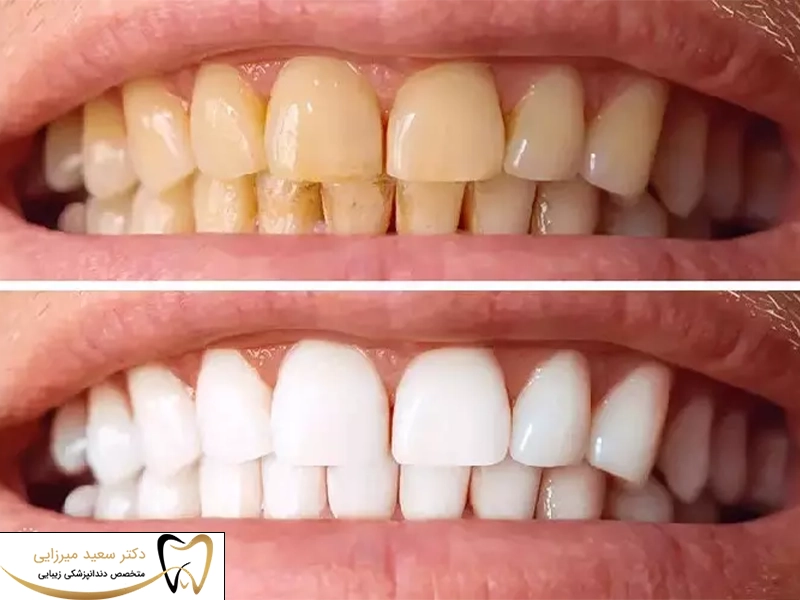 بیلیچینگ دندان